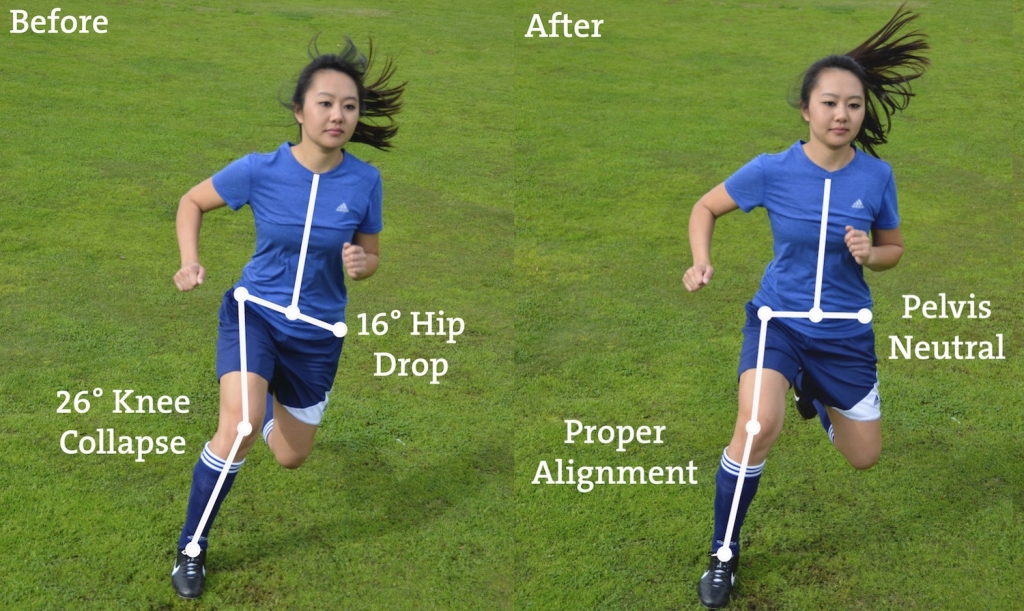 Who Needs Knees Why ACL injury prevention matters Stride Physio